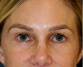 Feel Beautiful - Blepharoplasty Upper/Lower Eyelids 106 - After Photo